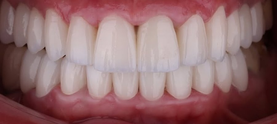 After treatment