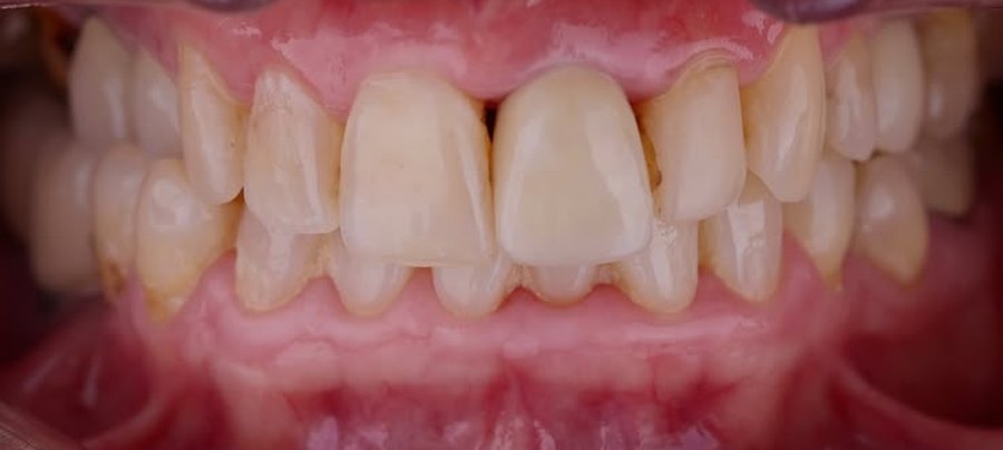 Before treatment