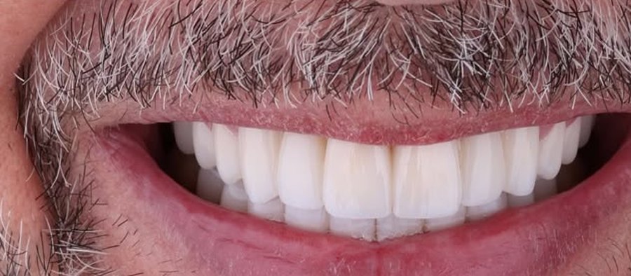 After treatment