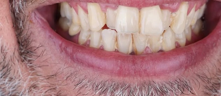 Before treatment