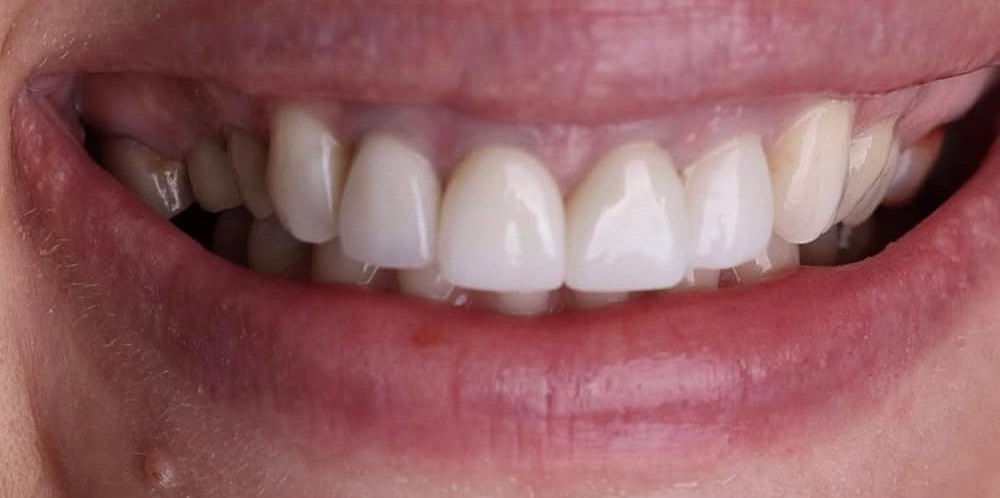 Before treatment